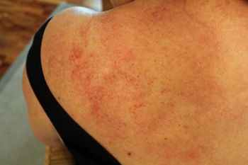 Heilverfahren Gua Sha